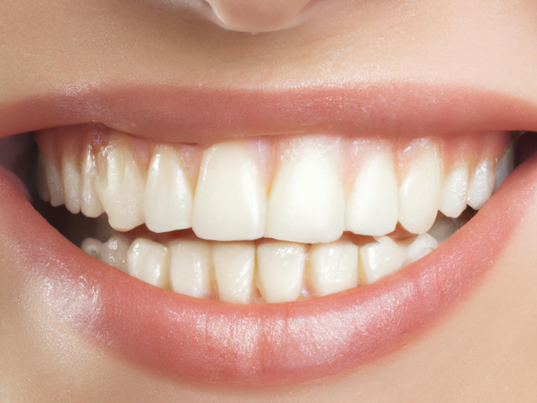 Best Veneers Clinics in Medellín (2026): What to Pay, Who to Trust, How Not to Wreck Your Teeth - medellín.guide